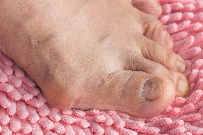 What's A Bunion and Why Should I Care?